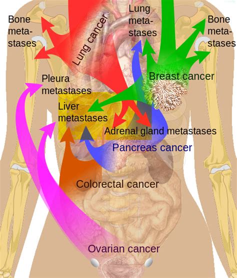 Transplant Surgery - Liver Metastases