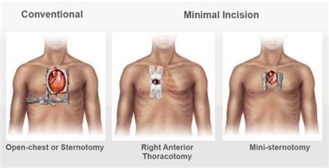 Keyhole Aortic Valve Surgery - Mr. Kulvinder Lal