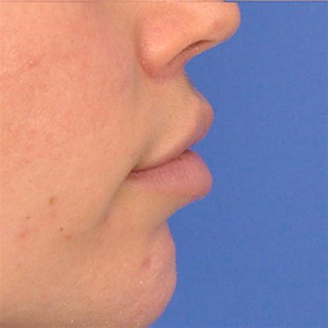 Patient 163834827 | Lip Lift Before & After Photos | Guelph Plastic Surgery