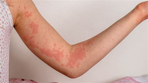 Dr Medico Allergic Reaction Skin Rash Treatment - vrogue.co