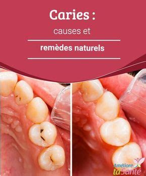 Caries : causes et remèdes naturels Les caries sont fréquentes et il est parfois difficile de s ...