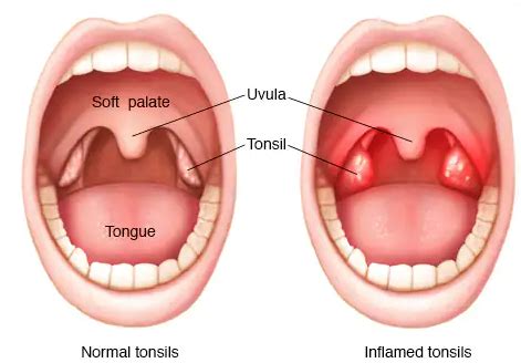 Clear Blisters On Tonsils