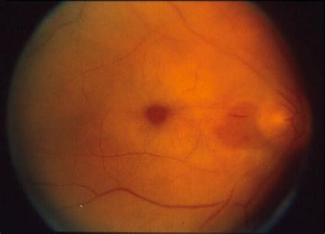 Central retinal artery - wikidoc