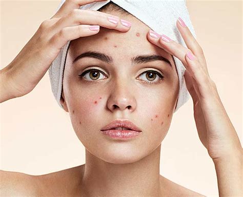 Have Acne Prone Skin? Here Are Some Things You Should Avoid Doing | HerZindagi