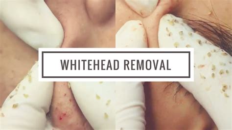 Whitehead Removal Videos