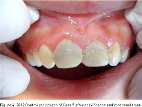 Mineral trioxide aggregate as a pulpotomy agent in immature teeth: Long-term case report ...