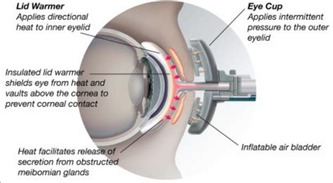 Atrophy of Meibomian glands – Prevent, avoid, reduce, relieve, treat, and cure eye pain and eye ...