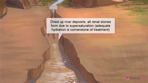 Calcium Oxalate Stones & Calcium Phosphate Stones - Free Sketchy Medical Lesson