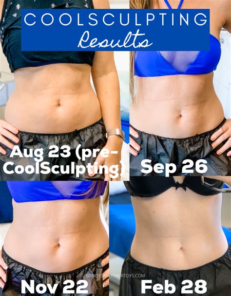 My CoolSculpting Results are in! - My Boys and Their Toys | Coolsculpting results, Cool ...