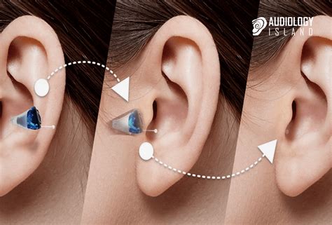 CROS and BiCROS hearing aids - Audiology Island