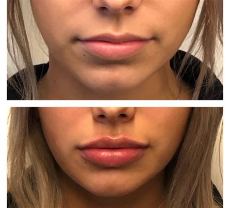 Juvederm Lips Before and After