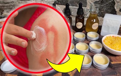 Natural ointment, grandma's powerful remedy that fights skin irritations (including psoriasis ...