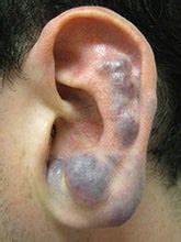 vascular-malformations-blue-rubber-bleb-nevus-syndrome-3x4-180x240.jpg ...