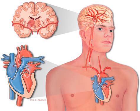 Monitoring Symptoms of Stroke – Heart Rate Monitors USA