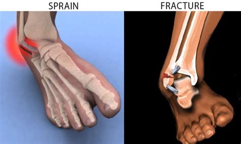 Ankle Sprain VS Broken Ankle – Welcome to SYS Medtech International Pvt. Ltd.