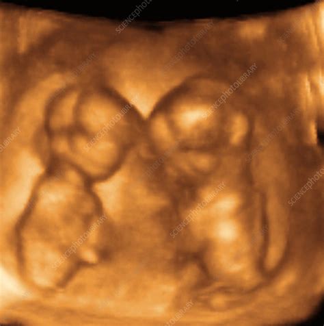 Twins, 3-D ultrasound scan - Stock Image - P680/0648 - Science Photo Library