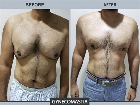 Gyno - Gynecomastia Surgery, Treatment & Causes - Flashy Info