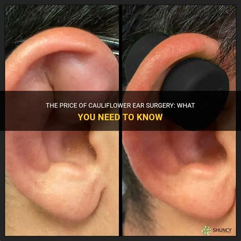 The Price Of Cauliflower Ear Surgery: What You Need To Know | ShunCy