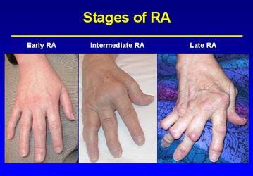 Rheumatoid Arthritis: Causes, Symptoms and Treatment | IYTmed.com