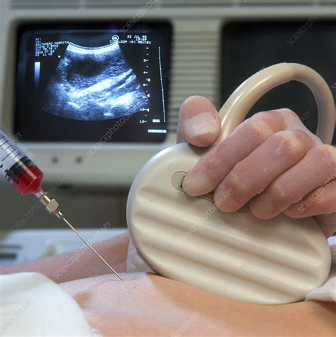 Chorionic villus sampling with needle & ultrasound - Stock Image - M800/0038 - Science Photo Library