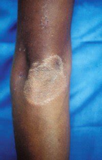 What does leprosy look like? - Leprosy Mission International