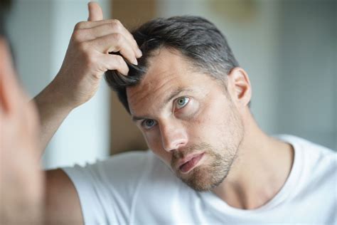 What Is Androgenic Alopecia Treatment? - Dillon Hair Restoration in Schaumburg, IL 60173