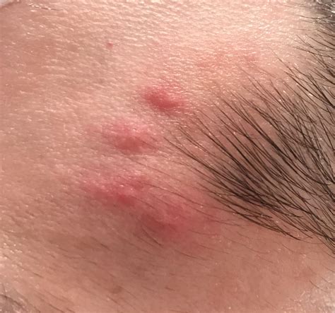 [Skin Concerns] Help! I’ve had these bumps near my hairline for a few ...