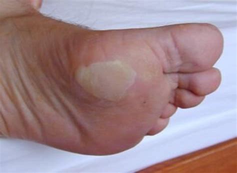 PODIATRIST DISCUSSES BEST TREATMENT FOR BLISTERS