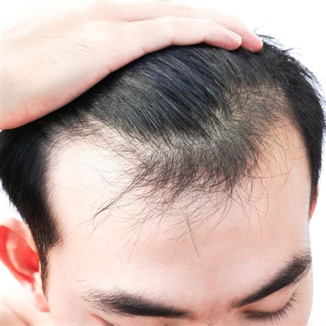 Stress and Hair Loss – Cosmedica Clinic | Dr. Levent Acar