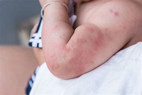 17 Most Common Types of Baby Rashes (With Pictures)