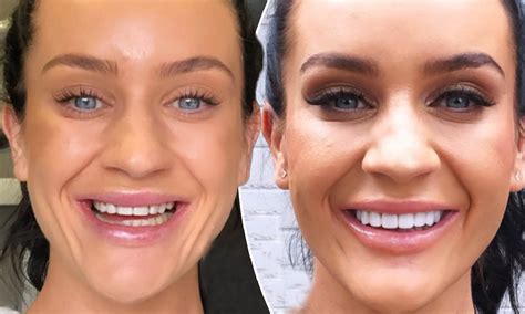 Celebrities With Veneers Before And After