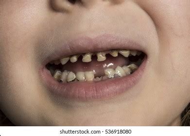 Ugly People Rotten Teeth