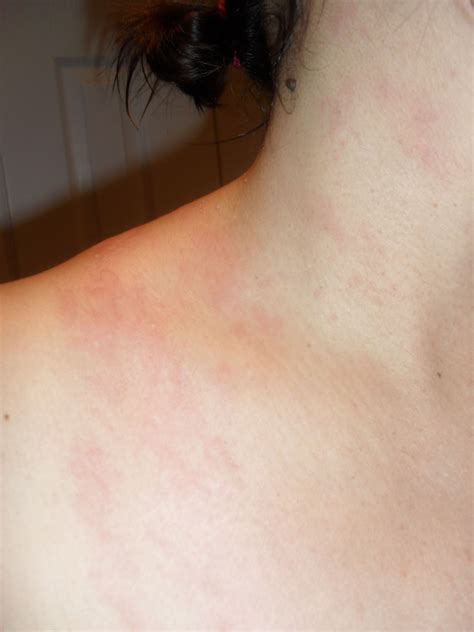 Skin rash celiac disease – Artofit