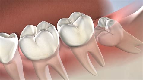 Normal Tooth Extraction Healing Pictures