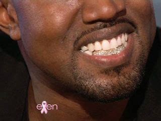 Kanye West Teeth Before And After Photos; Kanye West Replaces His Bottom Teeth With Diamonds