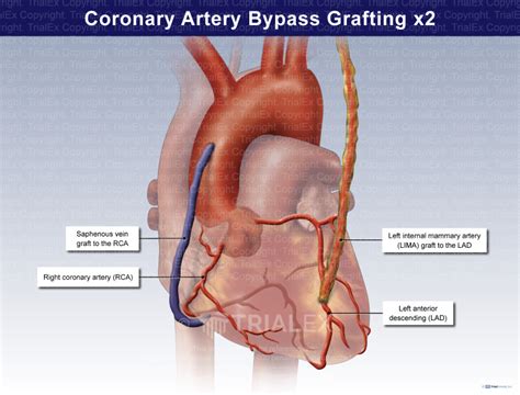 Coronary Artery Bypass Grafting x2 - TrialQuest Inc.