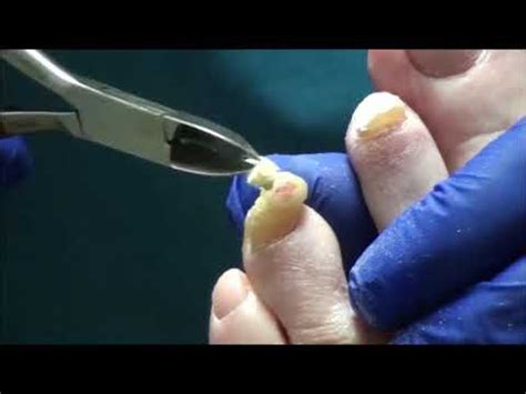 Rams Horn Nail Treatment by Dr Nail Nipper - Dr Nail Nipper