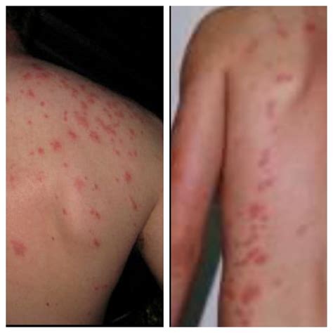 Carpet Beetle Rash Vs Bed Bug Bites | Two Birds Home