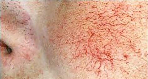 Telangiectasias | Broken Capillaries | Contour Dermatology