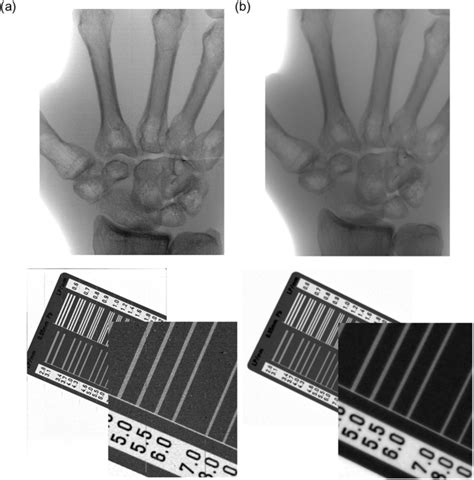 Direct Thermal Growth of Large Scale Cl-doped CdTe Film for Low Voltage High Resolution X-ray ...