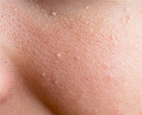 Milia (Milk Spots): Causes & Treatment