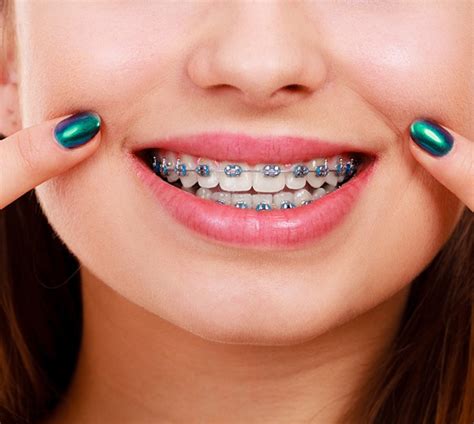 Braces with Missing Teeth Allen | Correct Dental Misalignment | Allen ...