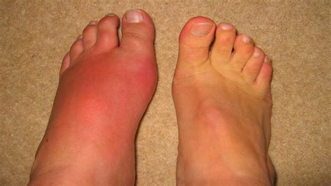 Gout in Pictures - Experiments on Battling Gout