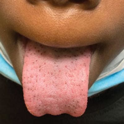 Hyperpigmented Papules on the Tongue of a Child | MDedge Dermatology