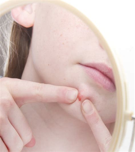 Dermatillomania: Symptoms, Causes, And Treatment