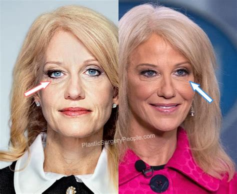 Kellyanne Conway: BEFORE and AFTER 2022