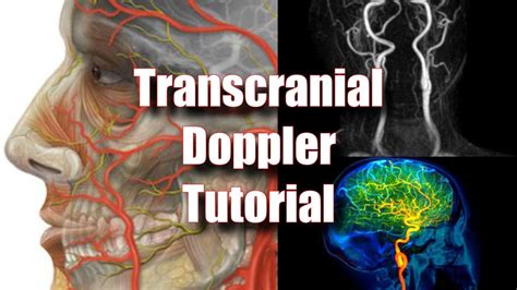 Transcranial Doppler | Vascular ultrasound, Sonography, Ultrasound