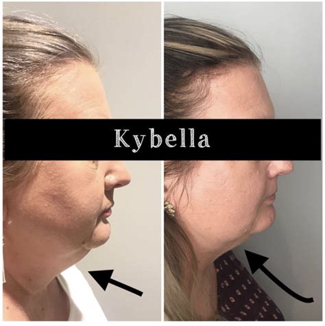 Medical Kybella Injections in Gilbert | Colair Med Spa