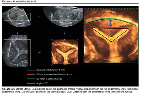 Nagendra's Radiology Blog: SEPTATE AND ARCUATE UTERUS ----PICTORIAL DIAGNOSTIC FEATURE