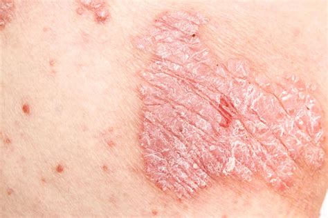 Genital psoriasis: Symptoms, treatment, and causes (2023)